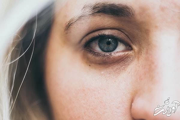 علت تیرگی دور چشم 